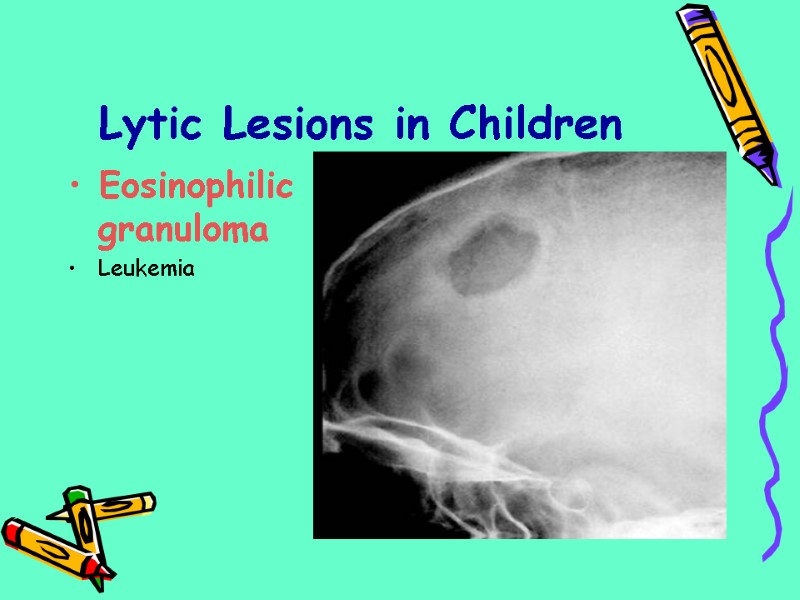 Lytic Lesions in Children Eosinophilic granuloma Leukemia